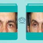 نمونه کار لیفت ابرو