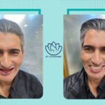 نمونه کار ایمپلنت