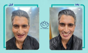 نمونه کار ایمپلنت