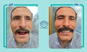 نمونه کار ایمپلنت