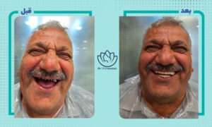 نمونه کار ایمپلنت