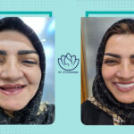 نمونه کار ایمپلنت