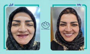 نمونه کار ایمپلنت