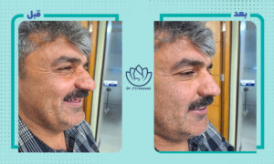 نمونه کار ایمپلنت