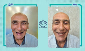 نمونه کار ایمپلنت