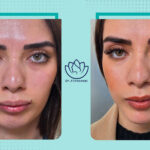 نمونه جراحی فک( بایمکس)