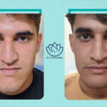 نمونه جراحی فک( بایمکس)
