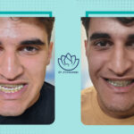 نمونه جراحی فک( بایمکس)