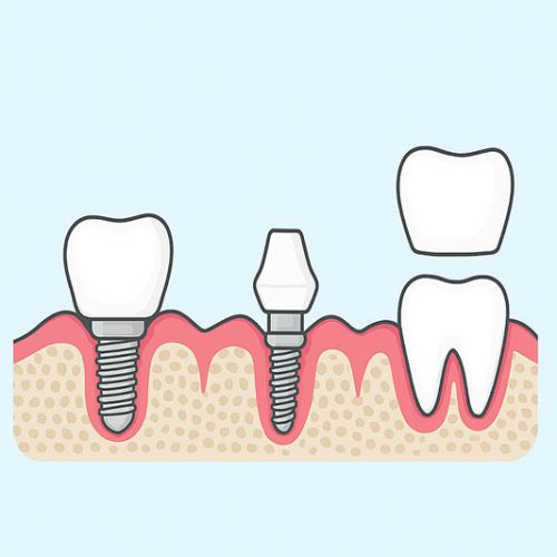 قرار دادن قطعه رابط و قالب‌گیری