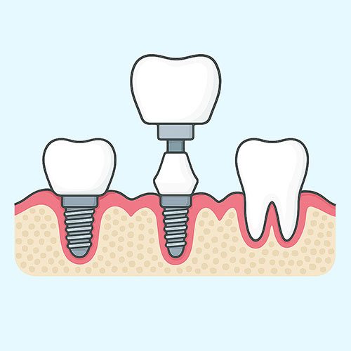 مرحله پنجم نصب روکش روی اباتمنت2
